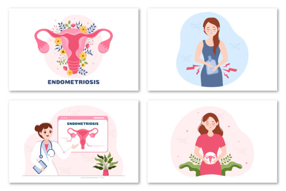 13 Endometriosis Illustration