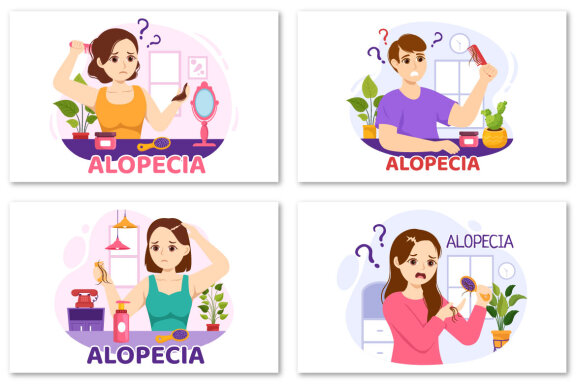 11 Alopecia Hair Loss Illustration